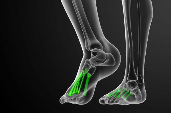 Metatarsal Stress Fractures